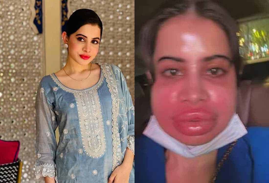 Urfi javed gets lip filler dissolved video viral on internet